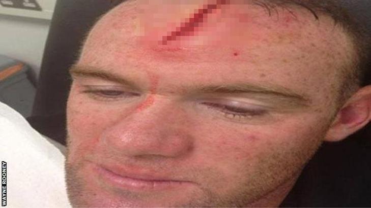 Rooney'nin kafası yarıldı