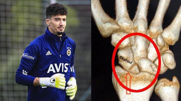 Skafoid Kırığı nedir? Skafoid kemiği neresi, tedavisi kaç ay sürer? Fenerbahçe'de Altay Bayındır'ın sakatlığı...