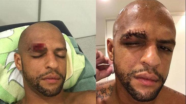 Felipe Melo'ya nazar değdi!