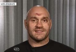 Deontay Wilder'la berabere kalan Tyson Fury'nin yüzü savaş alanı gibi!