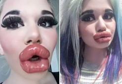 Bulgaristan'da genç kız Barbie'ye özenip 20'den fazla dudak dolgusu yaptırdı