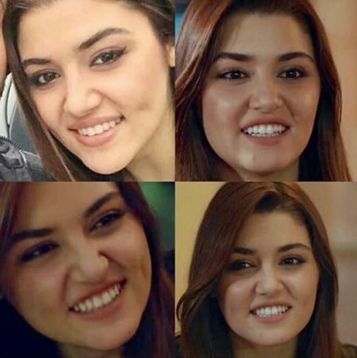 Hande Erçelin yüzüne ne oldu