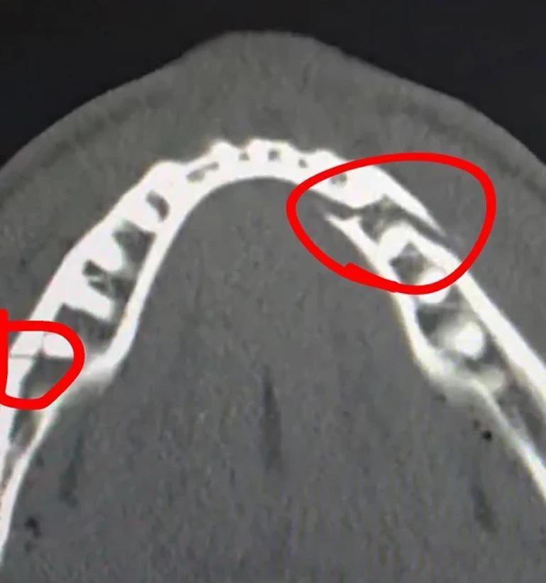 Çenesi kırıldı ama saniyede 93 bin dolar kazandı Jake Paulden son durumu için açıklama